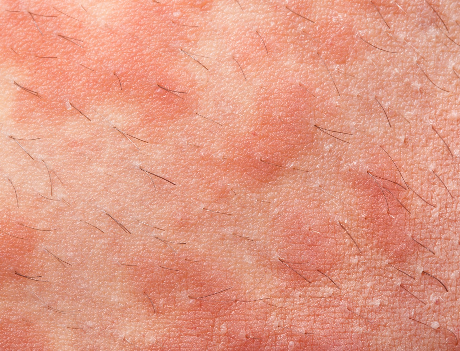 Random Rash Appearance Rashes | Idaho Dermatology
